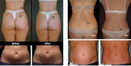 Four before-and-after body-contouring comparisons showing the thighs, waist and abdomen